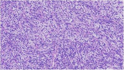 Risk factors for recurrent disease after resection of solitary fibrous tumor: a systematic review